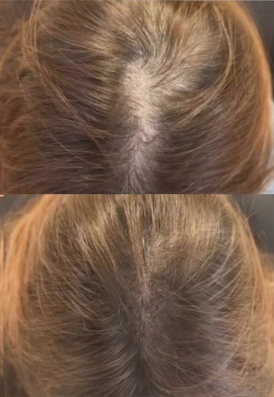 頭皮アートメイク症例1